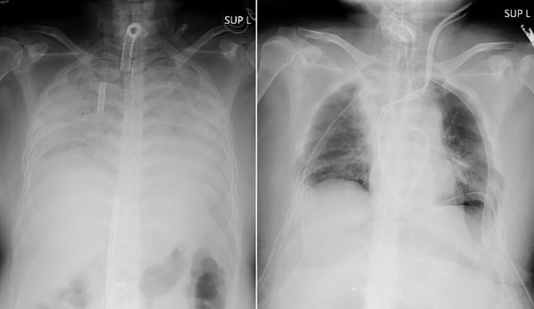 COVID-19 Patient Receives Lung Transplant From Living Donors